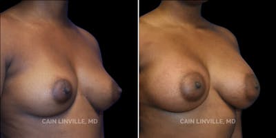Breast Augmentation Before & After Gallery - Patient 8522912 - Image 4