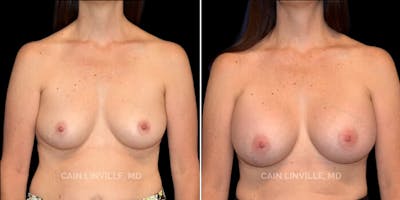 Breast Augmentation Before & After Gallery - Patient 8522925 - Image 1