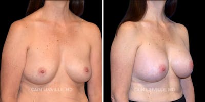 Breast Augmentation Before & After Gallery - Patient 8522925 - Image 2