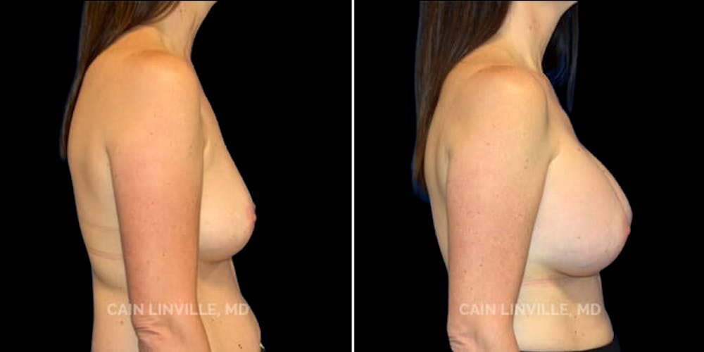 Breast Augmentation Before & After Gallery - Patient 8522925 - Image 3