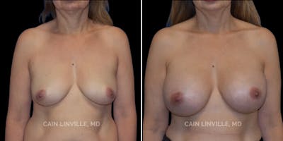 Breast Augmentation Before & After Gallery - Patient 8522938 - Image 1