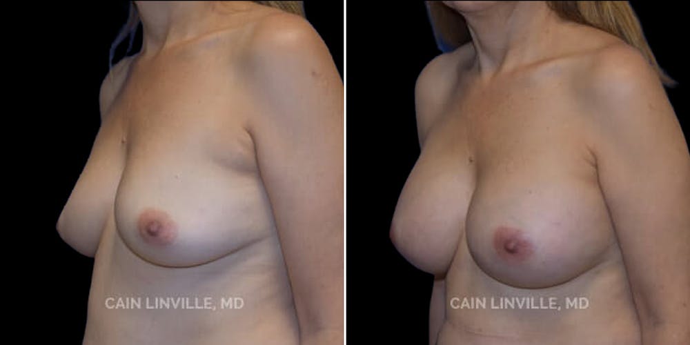 Breast Augmentation Before & After Gallery - Patient 8522938 - Image 2