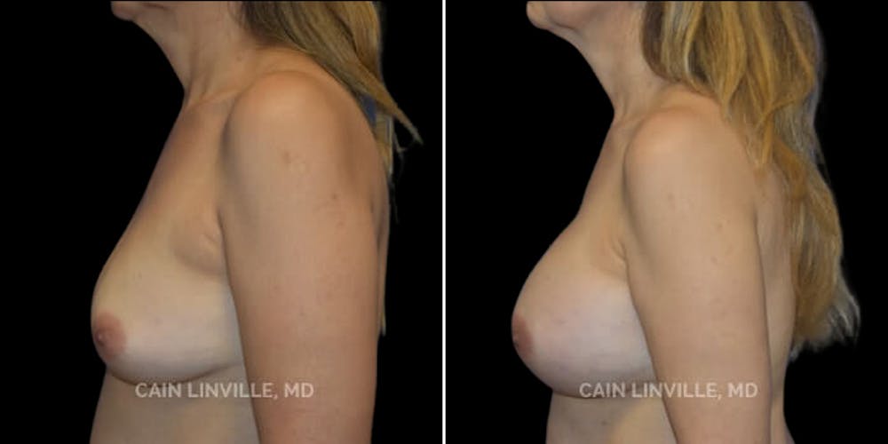 Breast Augmentation Before & After Gallery - Patient 8522938 - Image 3