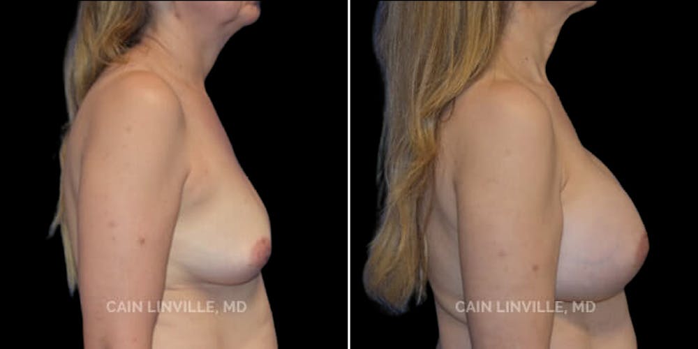 Breast Augmentation Before & After Gallery - Patient 8522938 - Image 4