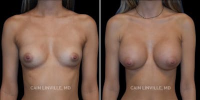 Breast Augmentation Before & After Gallery - Patient 8522954 - Image 1
