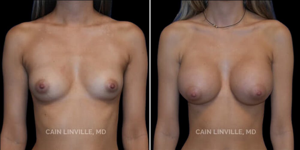 Breast Augmentation Before & After Gallery - Patient 8522954 - Image 1