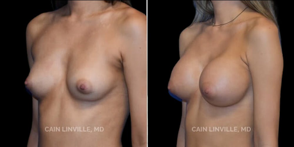 Breast Augmentation Before & After Gallery - Patient 8522954 - Image 2