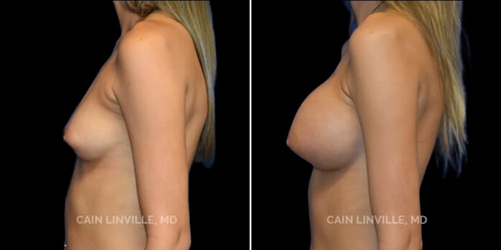 Breast Augmentation Before & After Gallery - Patient 8522954 - Image 3
