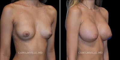 Breast Augmentation Before & After Gallery - Patient 8522954 - Image 4