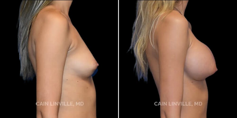 Breast Augmentation Before & After Gallery - Patient 8522954 - Image 5