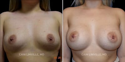 Breast Augmentation Before & After Gallery - Patient 8522975 - Image 1