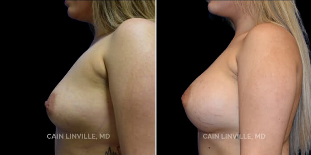 Breast Augmentation Before & After Gallery - Patient 8522975 - Image 3