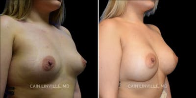 Breast Augmentation Before & After Gallery - Patient 8522975 - Image 4