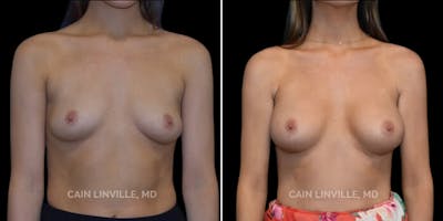 Breast Augmentation Before & After Gallery - Patient 8522993 - Image 1