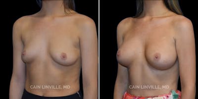 Breast Augmentation Before & After Gallery - Patient 8522993 - Image 2