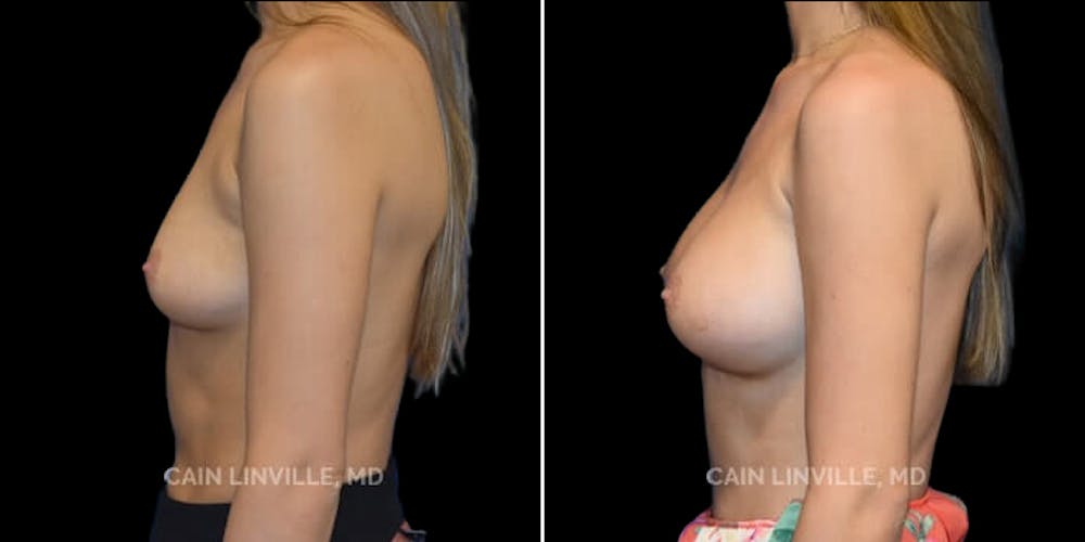 Breast Augmentation Before & After Gallery - Patient 8522993 - Image 3