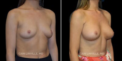 Breast Augmentation Before & After Gallery - Patient 8522993 - Image 4