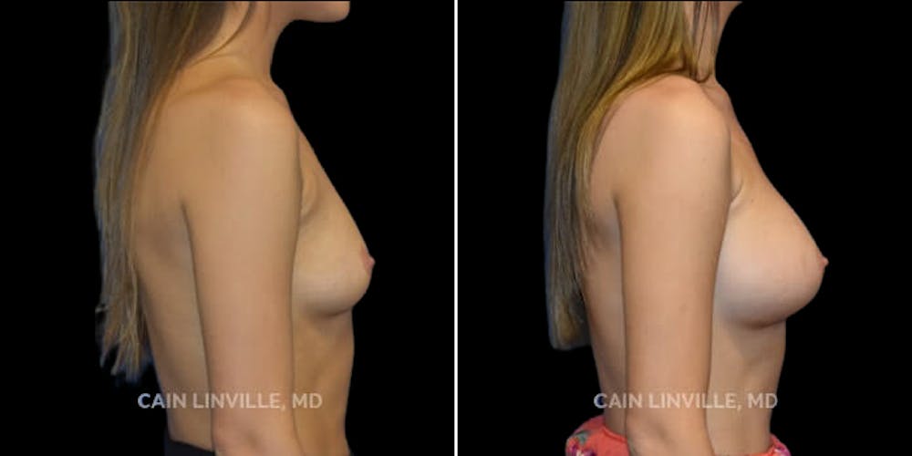 Breast Augmentation Before & After Gallery - Patient 8522993 - Image 5