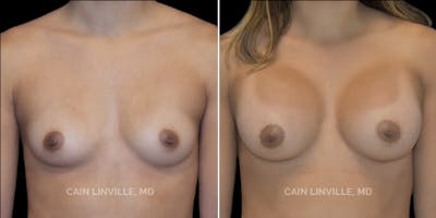 Breast Augmentation Before & After Gallery - Patient 8523014 - Image 1
