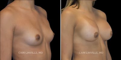 Breast Augmentation Before & After Gallery - Patient 8523014 - Image 2