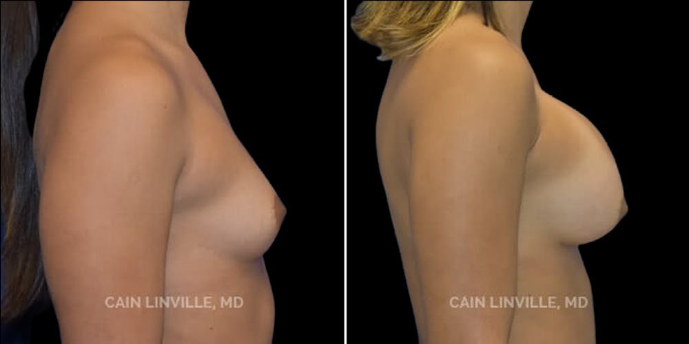 Breast Augmentation Before & After Gallery - Patient 8523014 - Image 3