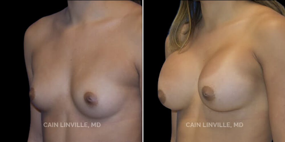 Breast Augmentation Before & After Gallery - Patient 8523014 - Image 4