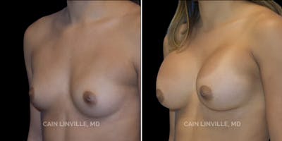 Breast Augmentation Before & After Gallery - Patient 8523014 - Image 4