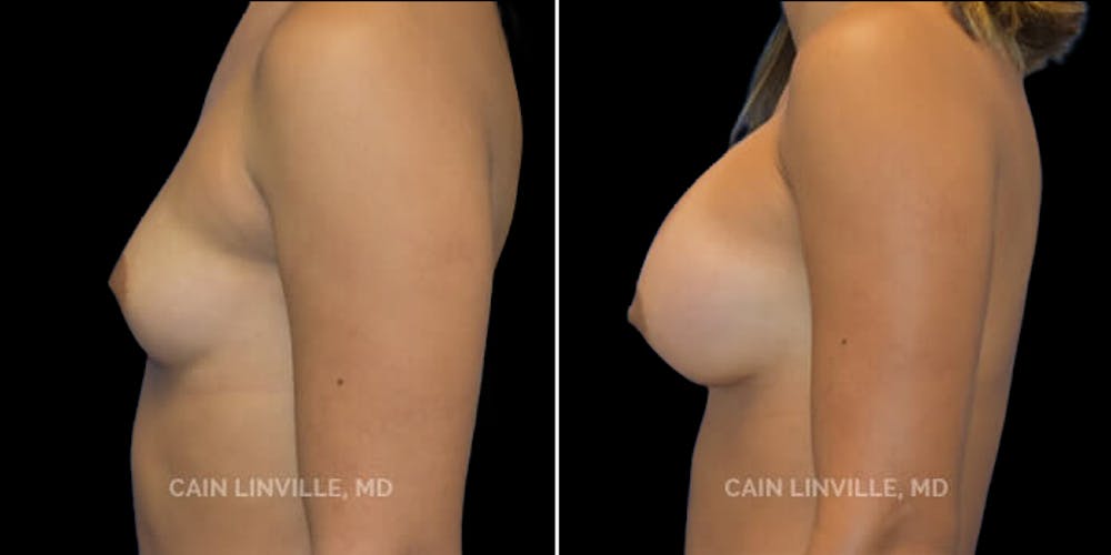 Breast Augmentation Before & After Gallery - Patient 8523014 - Image 5