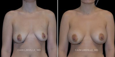 Breast Augmentation Before & After Gallery - Patient 8523027 - Image 1