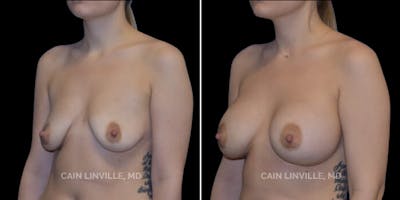 Breast Augmentation Before & After Gallery - Patient 8523027 - Image 2