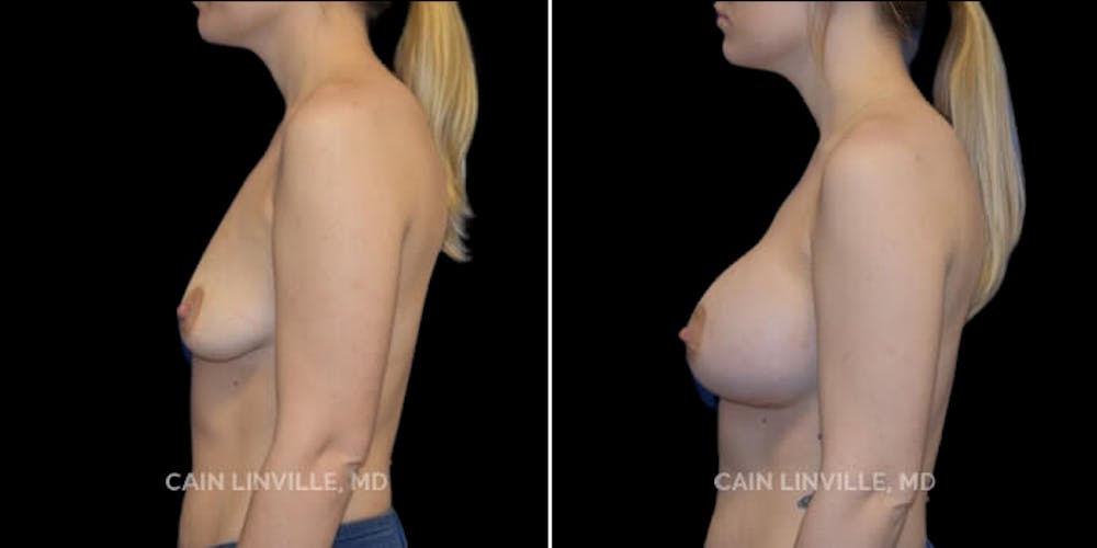 Breast Augmentation Before & After Gallery - Patient 8523027 - Image 3