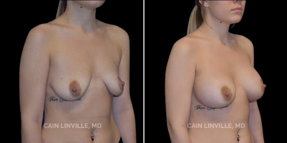 Breast Augmentation Before & After Gallery - Patient 8523027 - Image 4