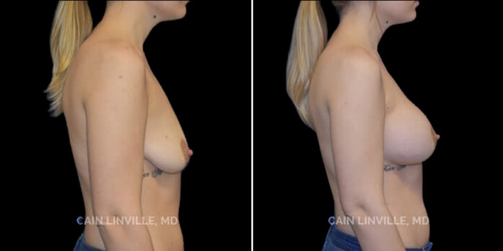 Breast Augmentation Before & After Gallery - Patient 8523027 - Image 5