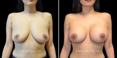 Breast Augmentation Before & After Gallery - Patient 8523043 - Image 1