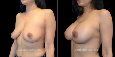 Breast Augmentation Before & After Gallery - Patient 8523043 - Image 2