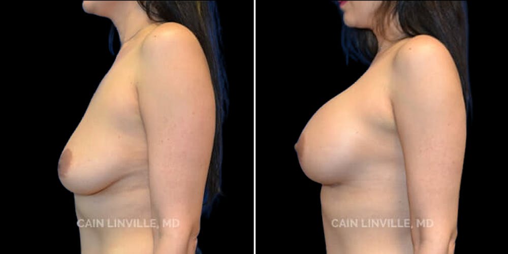 Breast Augmentation Before & After Gallery - Patient 8523043 - Image 3