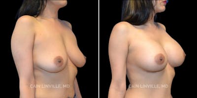 Breast Augmentation Before & After Gallery - Patient 8523043 - Image 4