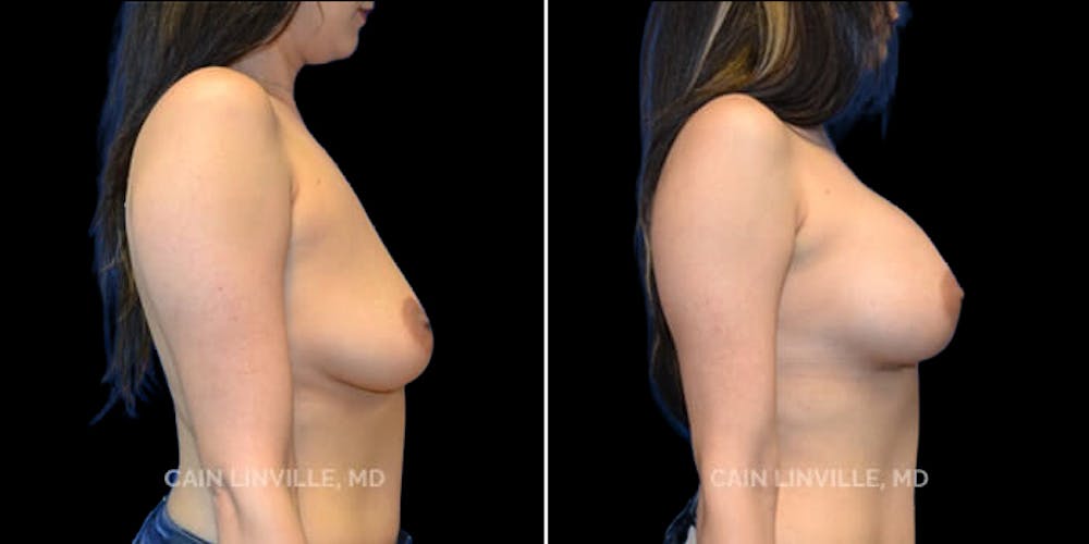 Breast Augmentation Before & After Gallery - Patient 8523043 - Image 5