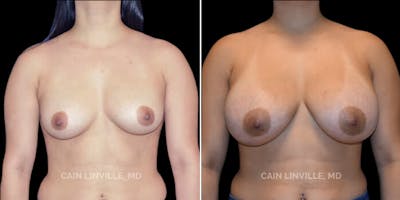 Breast Augmentation Before & After Gallery - Patient 8523059 - Image 1