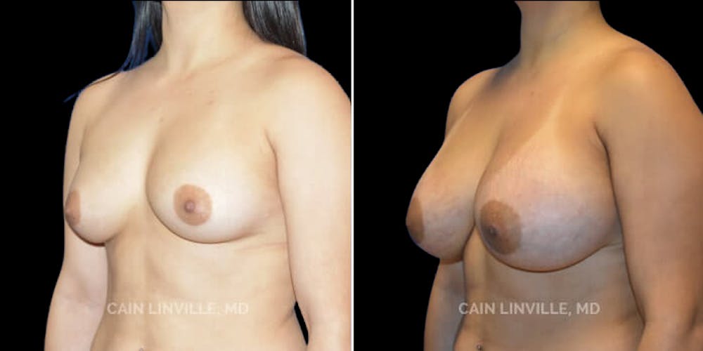 Breast Augmentation Before & After Gallery - Patient 8523059 - Image 2