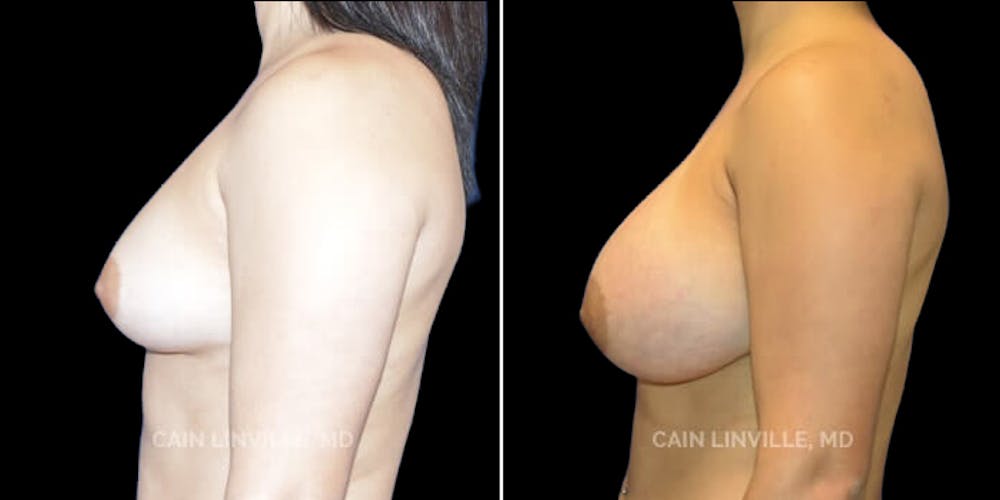Breast Augmentation Before & After Gallery - Patient 8523059 - Image 3