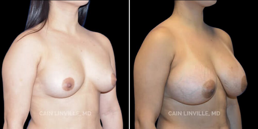 Breast Augmentation Before & After Gallery - Patient 8523059 - Image 4