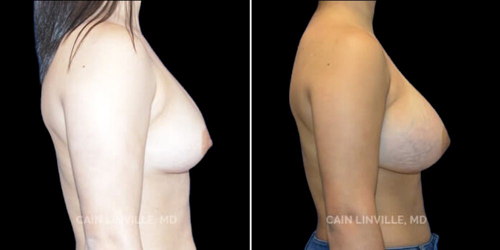 Breast Augmentation Before & After Gallery - Patient 8523059 - Image 5