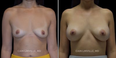 Breast Augmentation Before & After Gallery - Patient 8523078 - Image 1