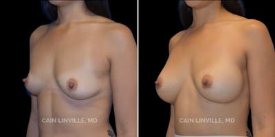 Breast Augmentation Before & After Gallery - Patient 8523078 - Image 2