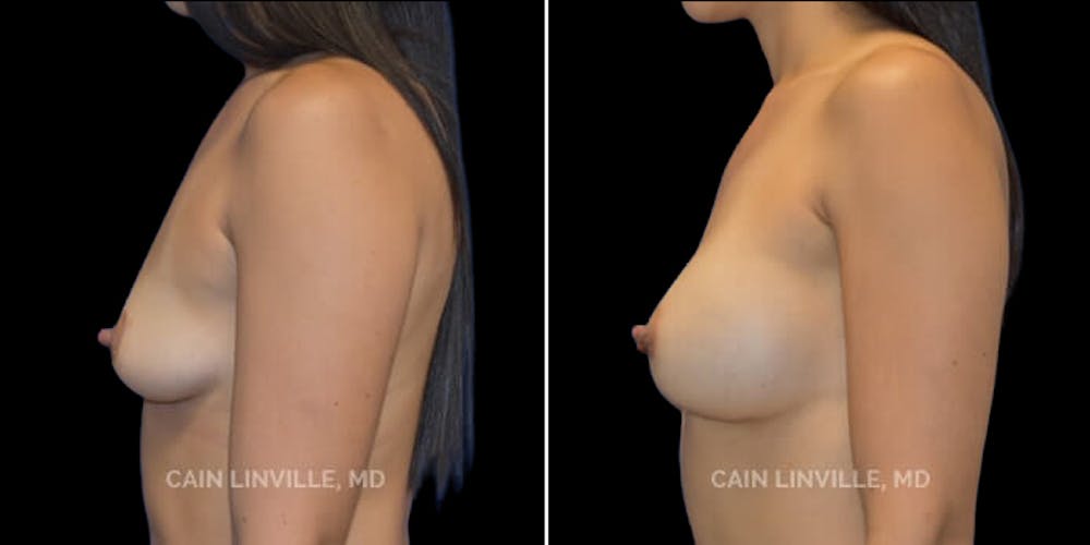 Breast Augmentation Before & After Gallery - Patient 8523078 - Image 3