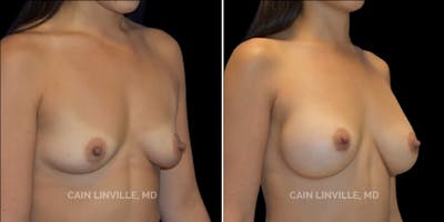Breast Augmentation Before & After Gallery - Patient 8523078 - Image 4