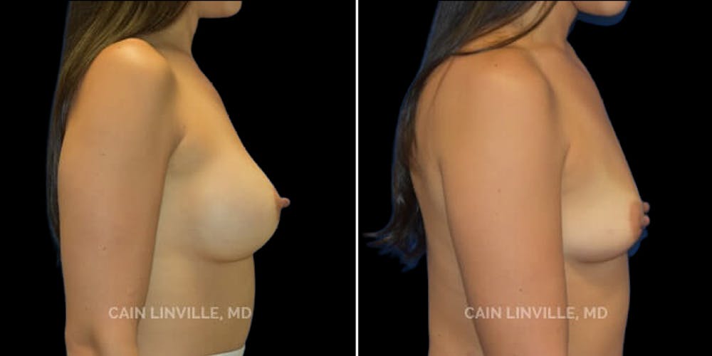 Breast Augmentation Before & After Gallery - Patient 8523078 - Image 5