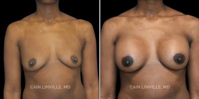 Breast Augmentation Before & After Gallery - Patient 8523126 - Image 1