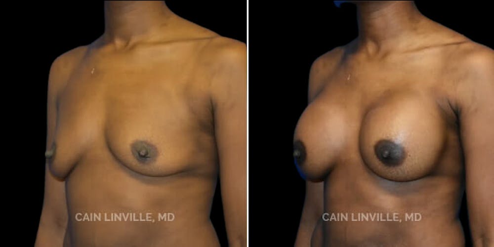 Breast Augmentation Before & After Gallery - Patient 8523126 - Image 2